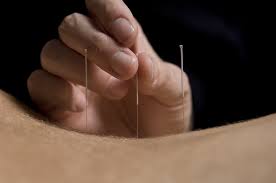 Acupuncture